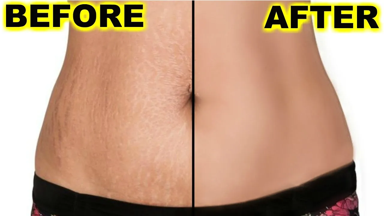 Stretch Marks Removal Treatment image 1