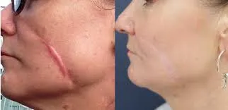 Scar Treatment image 1