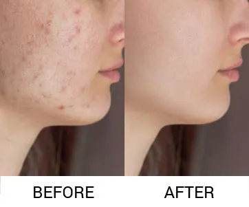 Mnrf For Acne Scar Treatment image 1