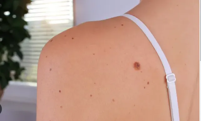 Mole/Wart/Tag Removal image 1