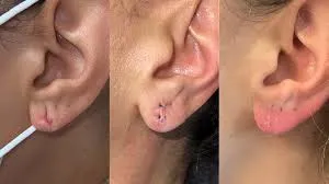 Ear Lobe Repair image 1