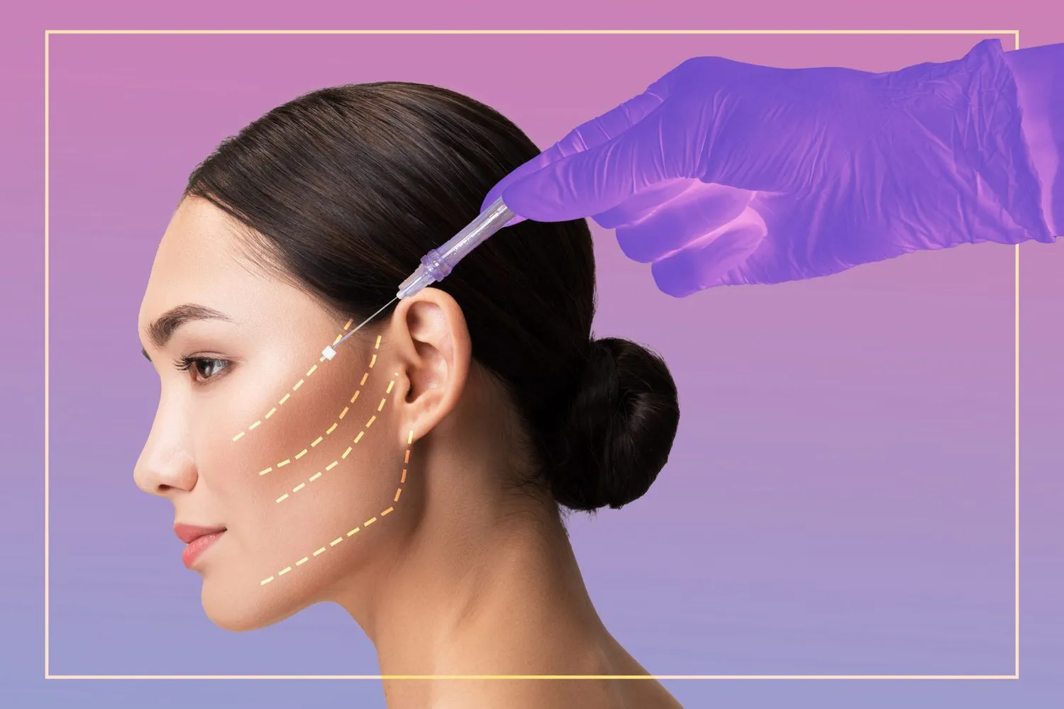 Thread Lift image 1