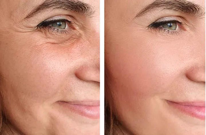 Non-Surgical Face Lift image 1