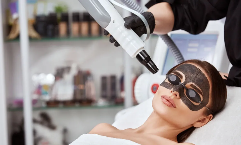 Carbon Laser Peel image 1