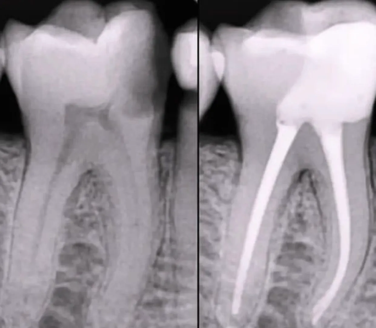 Root Canal Treatment image 1