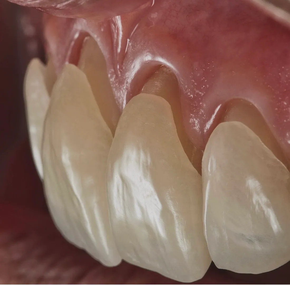 Dental Veneers image 1