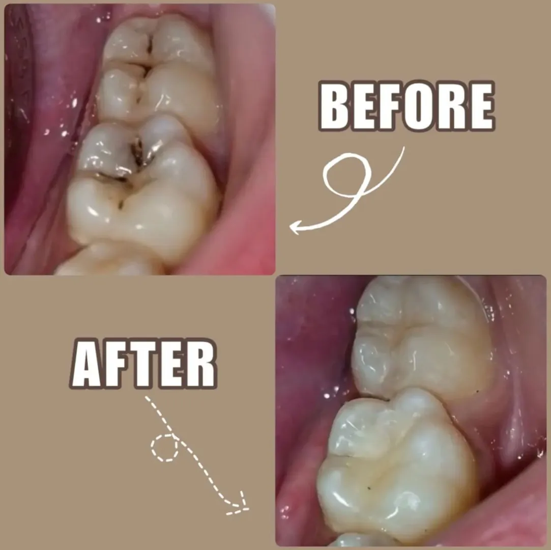 Filling / Restoration image 1