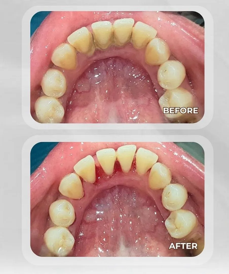 Scaling / Dental cleaning image 1