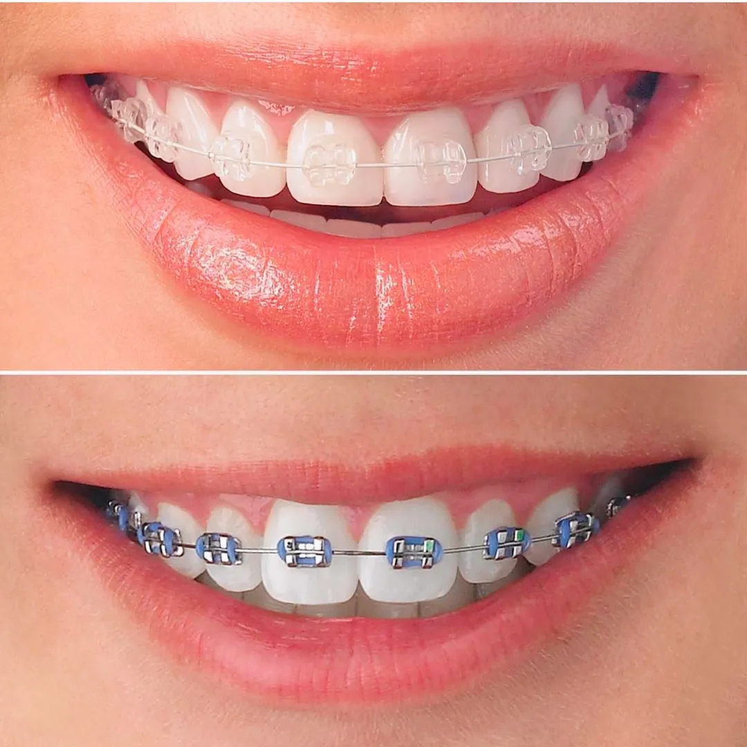 Orthodontic Braces image 1