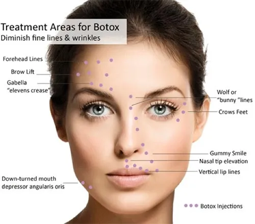 Botox  image 2