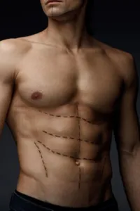 Liposuction - Plastic surgery for men image 1