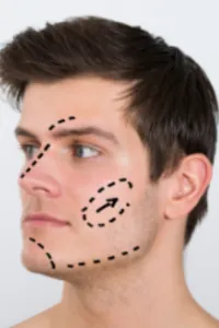 Face lift - Plastic surgery for men image 1
