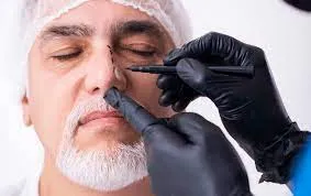 Septoplasty image 1