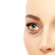 Upper and Lower Eyelid Blepharoplasty image 1