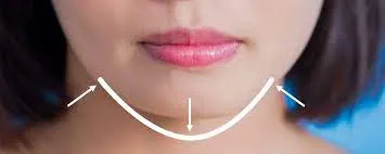 Chin Implants image 1