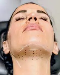 Double Chin Removal image 1