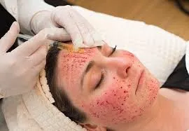 Vampire Facial image 1