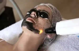 Carbon Peel image 1