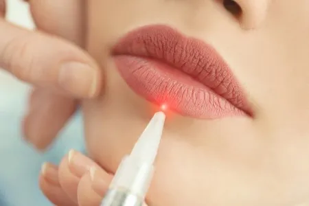 Laser Toning - Lip image 1