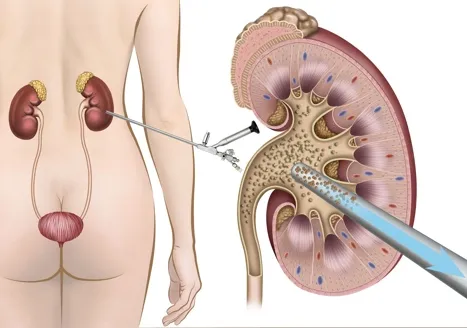 PCNL for Kidney Stones image 1