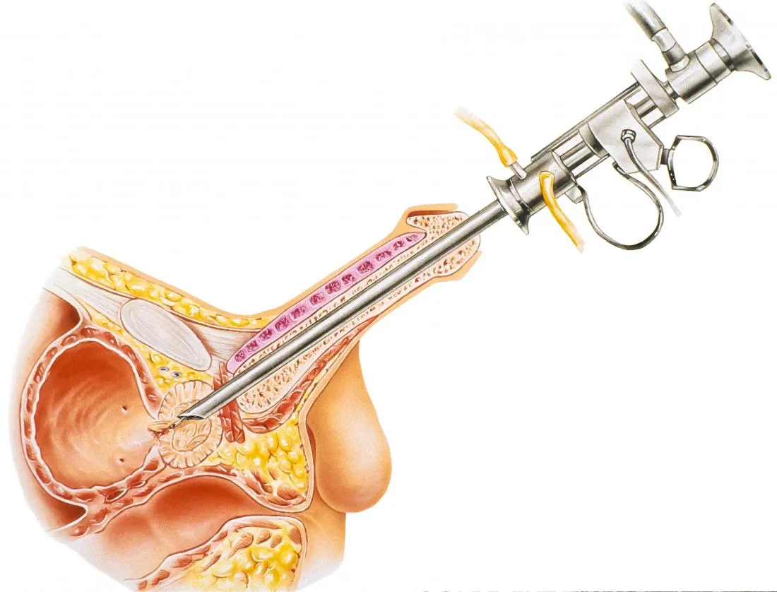 TURP for Prostate Surgery image 1