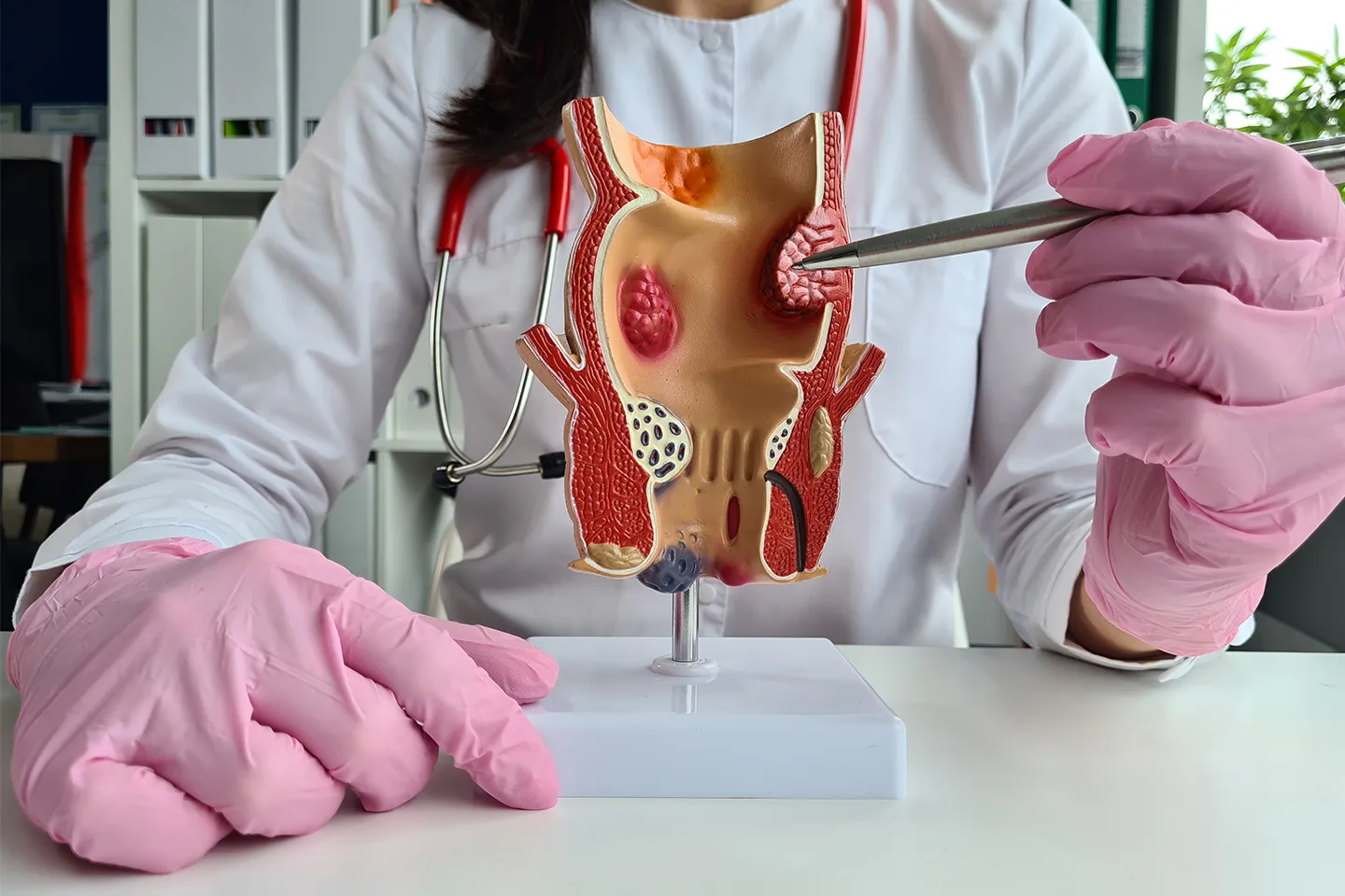 Hemorrhoidectomy (Surgery for Piles) image 1