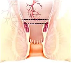 Chivate's Procedure for Piles image 1