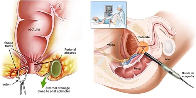 Laser Fistulotomy image 1