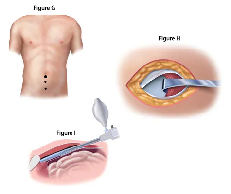 ROBOTIC SURGERY FOR COMPLEX ABDOMINAL HERNIAS  image 1