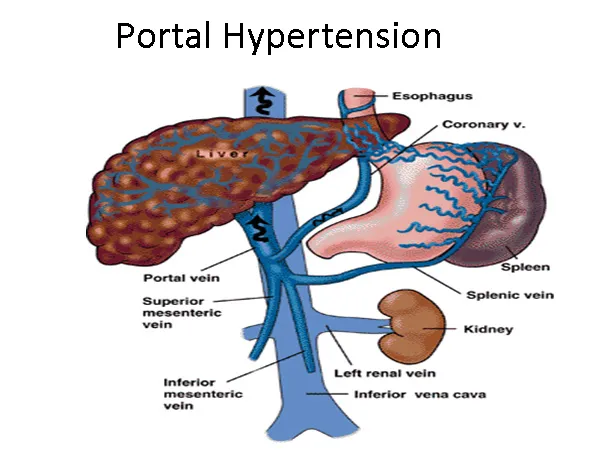 PORTAL HYPERTENSION  image 1