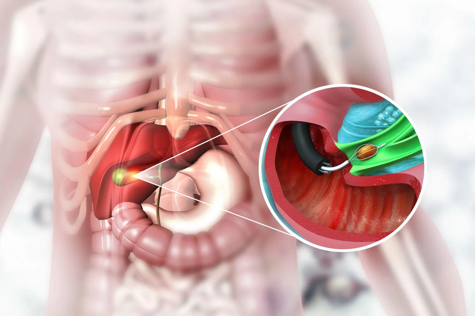 ROBOTIC GALL BLADDER AND BILIARY SURGERY image 1