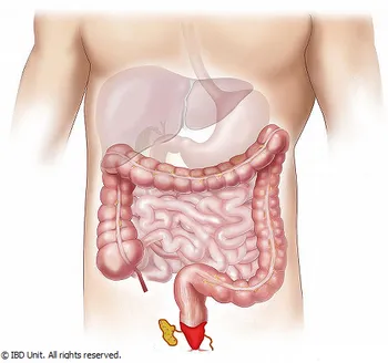 LARGE INTESTINE AND PERIANAL DISEASES image 1