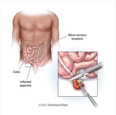 Appendix Surgey image 1