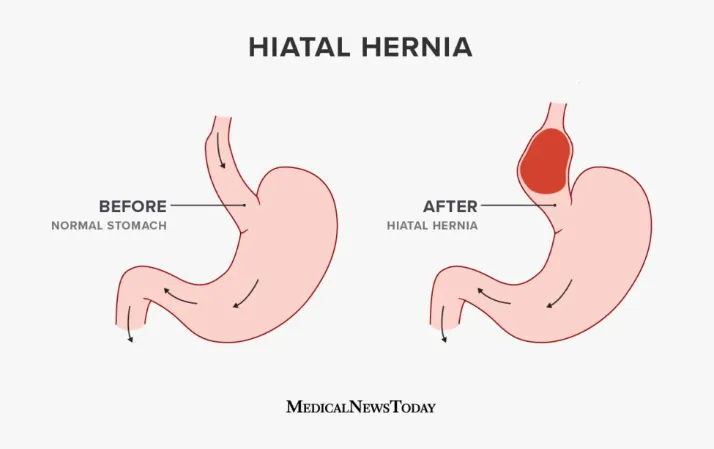 Fundoplication (Hiatus Hernia) image 1