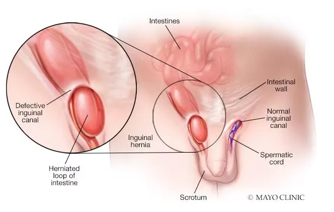 Inguinal Hernia image 1