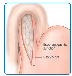 Laparoscopic Heller Procedure (Cardiomyotomy) image 1