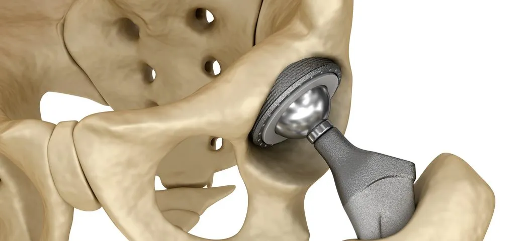 Implants image 1