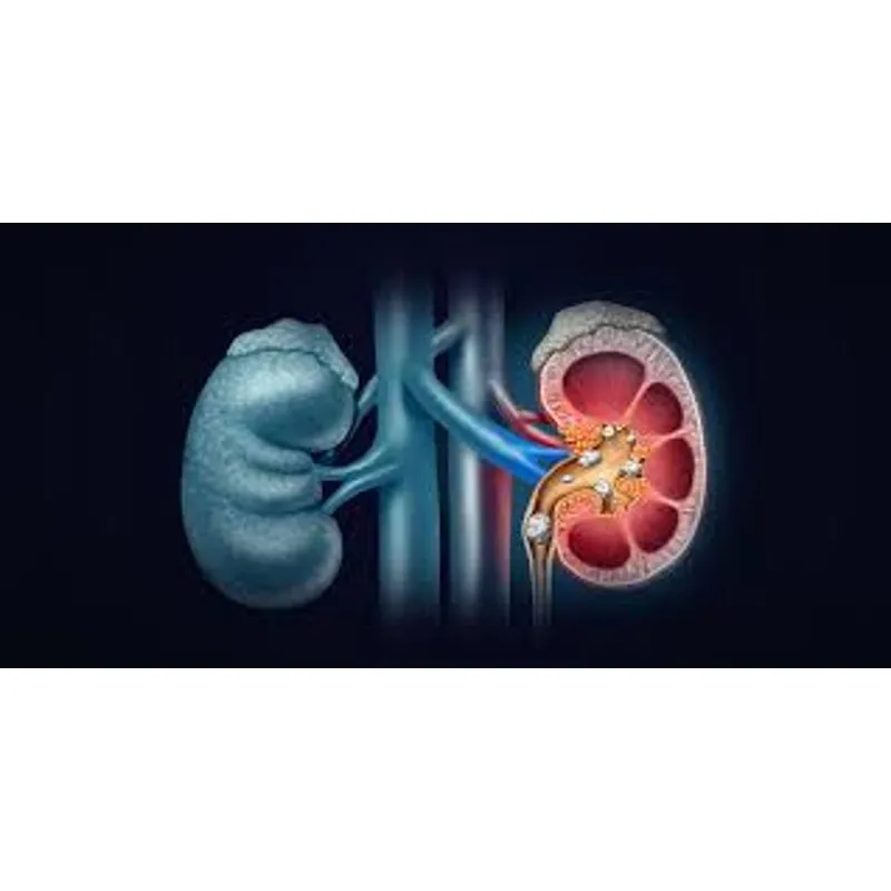KIDENY STONES SURGERY image 1