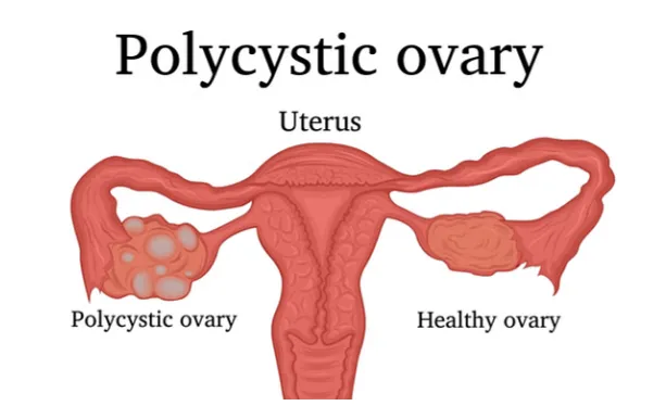 PCOS Treatment in Pune image 1