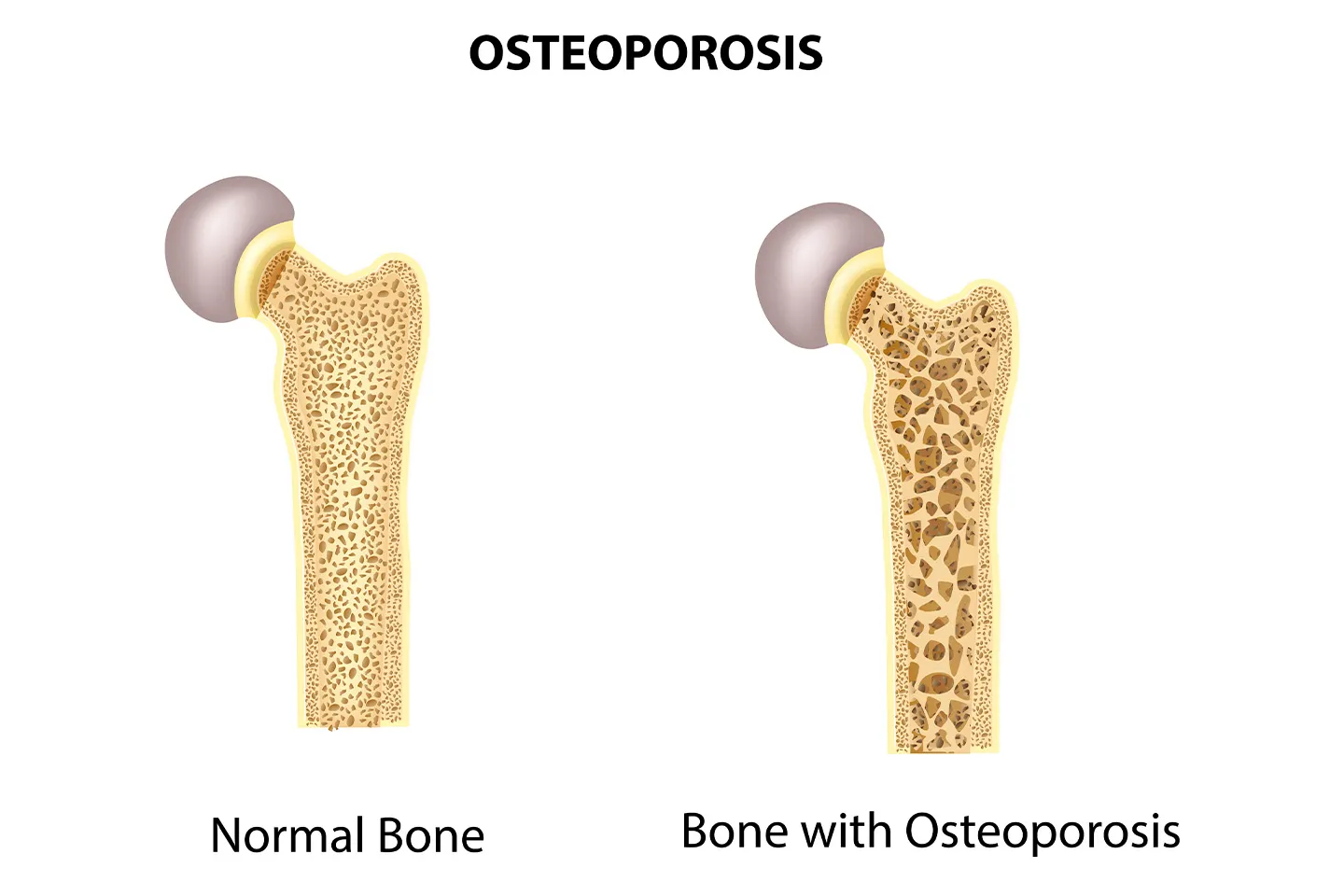 Osteoporosis Treatment in Pune image 1
