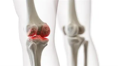 Bone Disorders Treatment in Pune image 1