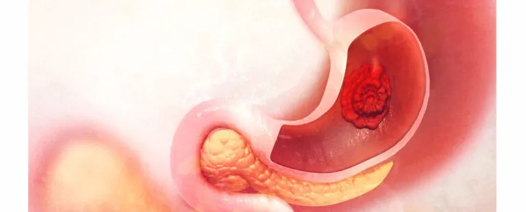 GI Cancers image 1