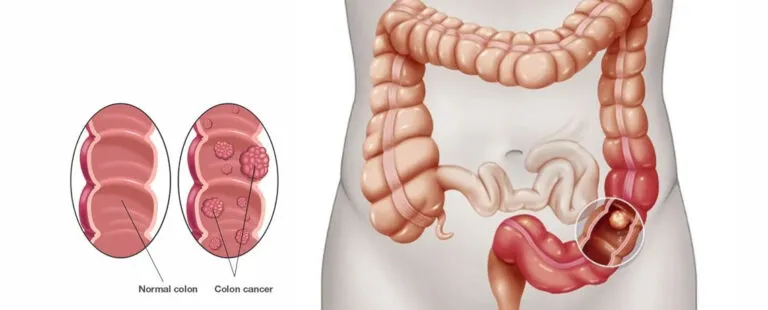 Colon Cancers image 1