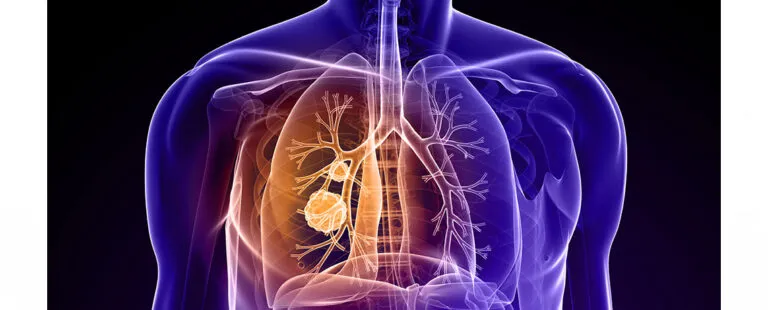 Lung Cancers image 1