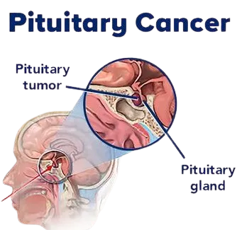 Endocrine Oncology Treatment in Pune image 1