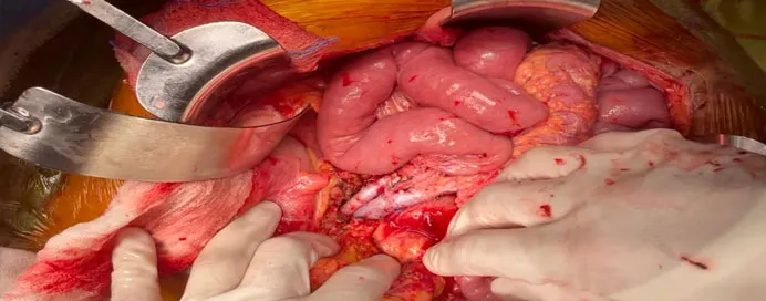 Intestine Rehabilitation And Transplantation image 1