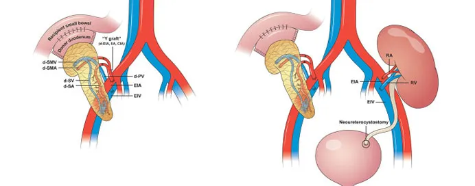 Pancreas Transplantation image 1