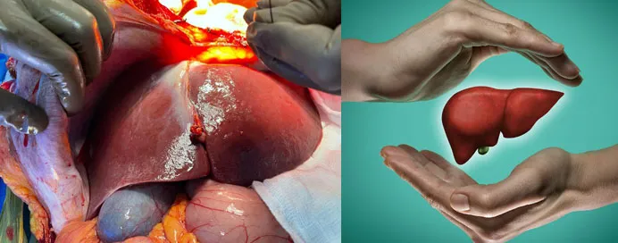 Liver Transplantation image 1