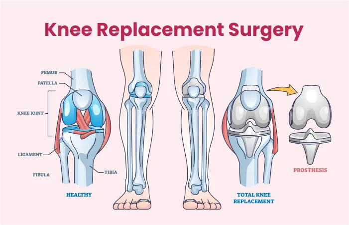 Knee Replacement  image 1
