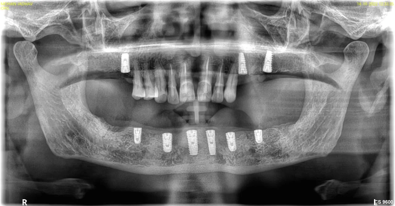 Dental Implants image 2